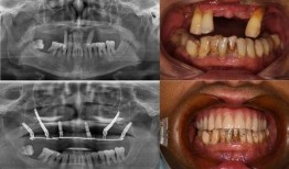 佛山种牙爆料事件视频曝光,揭露行业乱象引发关注
